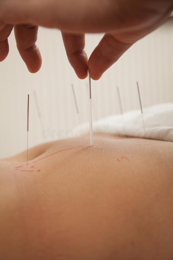 Acupuntura
